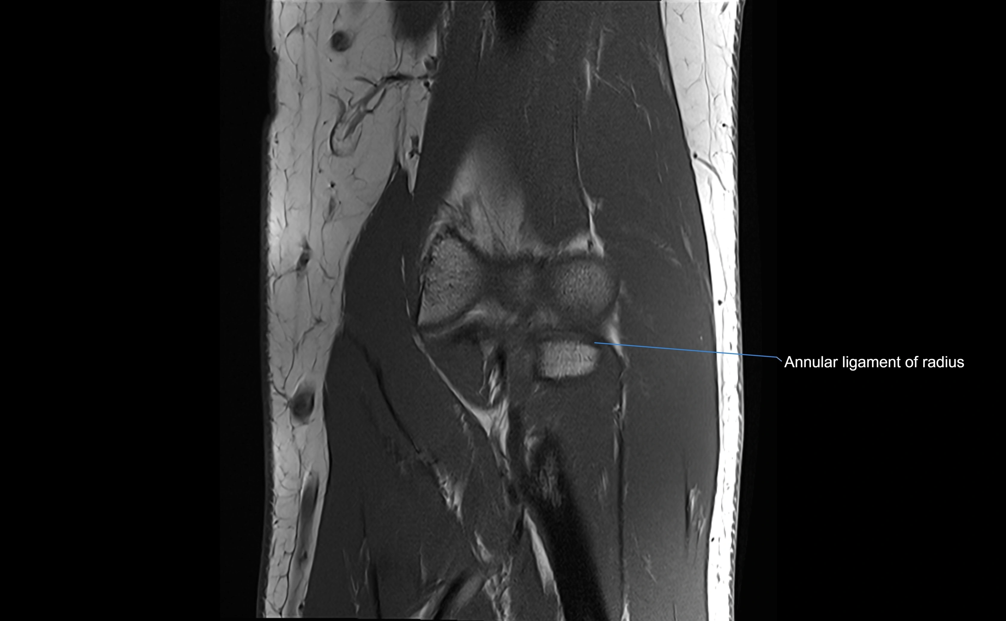 MRI elbow ligaments coronal cross sectional anatomy 3T  radiology  image-img-07001-00016.webp